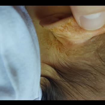 Bebek Ürünleri Cilt Sorunlarına Yol Açtı