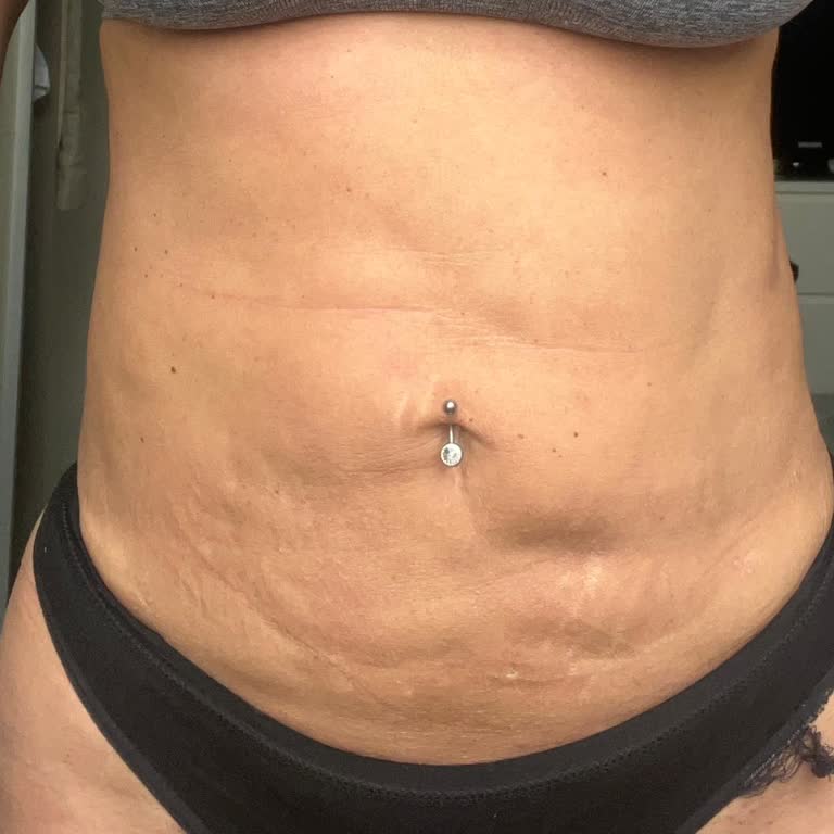 Vita Estetik Liposuction Sonrası İlgisizlik