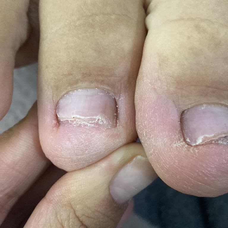 Mantar Tedavisi Ve Pedikürde Hayal Kırıklığı