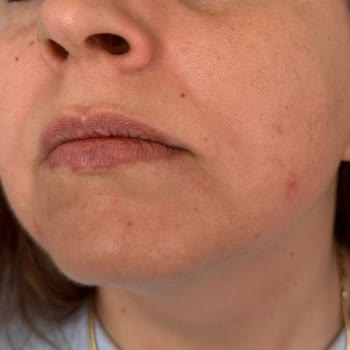 Avéne Dermabsolu Serisi İle Yaşanan Alerjik Reaksiyon