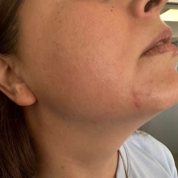 Avéne Dermabsolu Serisi İle Yaşanan Alerjik Reaksiyon