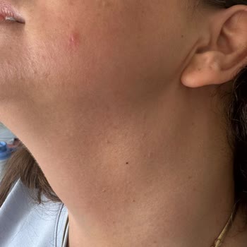 Avéne Dermabsolu Serisi İle Yaşanan Alerjik Reaksiyon