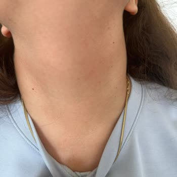 Avéne Dermabsolu Serisi İle Yaşanan Alerjik Reaksiyon