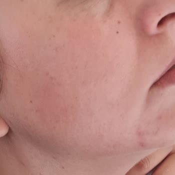 Avéne Dermabsolu Serisi İle Yaşanan Alerjik Reaksiyon