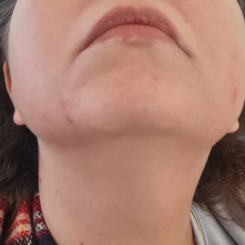 Avéne Dermabsolu Serisi İle Yaşanan Alerjik Reaksiyon