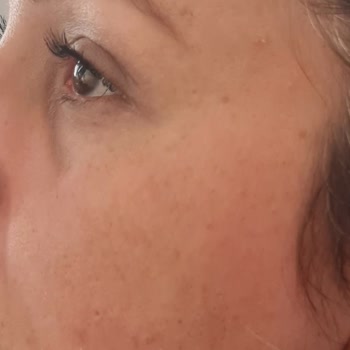 Avéne Dermabsolu Serisi İle Yaşanan Alerjik Reaksiyon