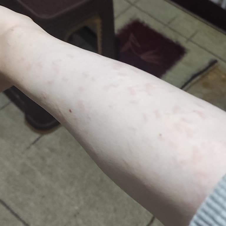 Üsküdar Şubesinde Düşük Standartlar Ve Yanık İzi Şikayeti