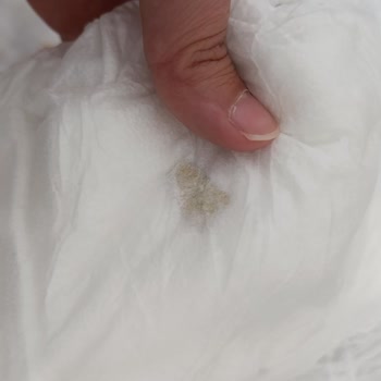 Bebek Bezi İçinde Bulunan Yabancı Madde Sorunu