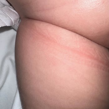 Dar Bebek Bezi Lastikleri Bebeğimi Rahatsız Ediyor!