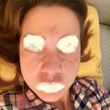 Yanıltıcı Cilt Tedavisi Ve Müşteri Memnuniyetsizliği