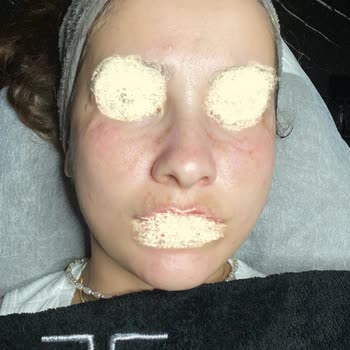 Yanıltıcı Cilt Tedavisi Ve Müşteri Memnuniyetsizliği