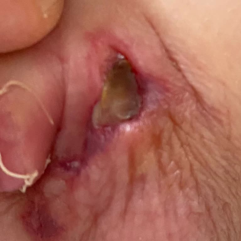 Sünnet Sonrası Yaşanan Sorun Ve Stres