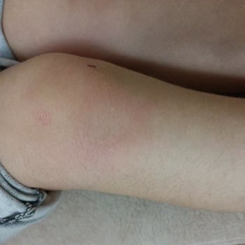 Bingo Antialerjik Deterjan Kızımın Cildini Mahvetti!