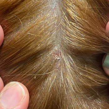 Palette Boyası: Saç Derisinde Yanma Ve Morarma Sorunu