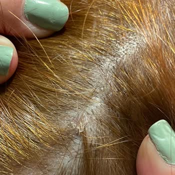 Palette Boyası: Saç Derisinde Yanma Ve Morarma Sorunu