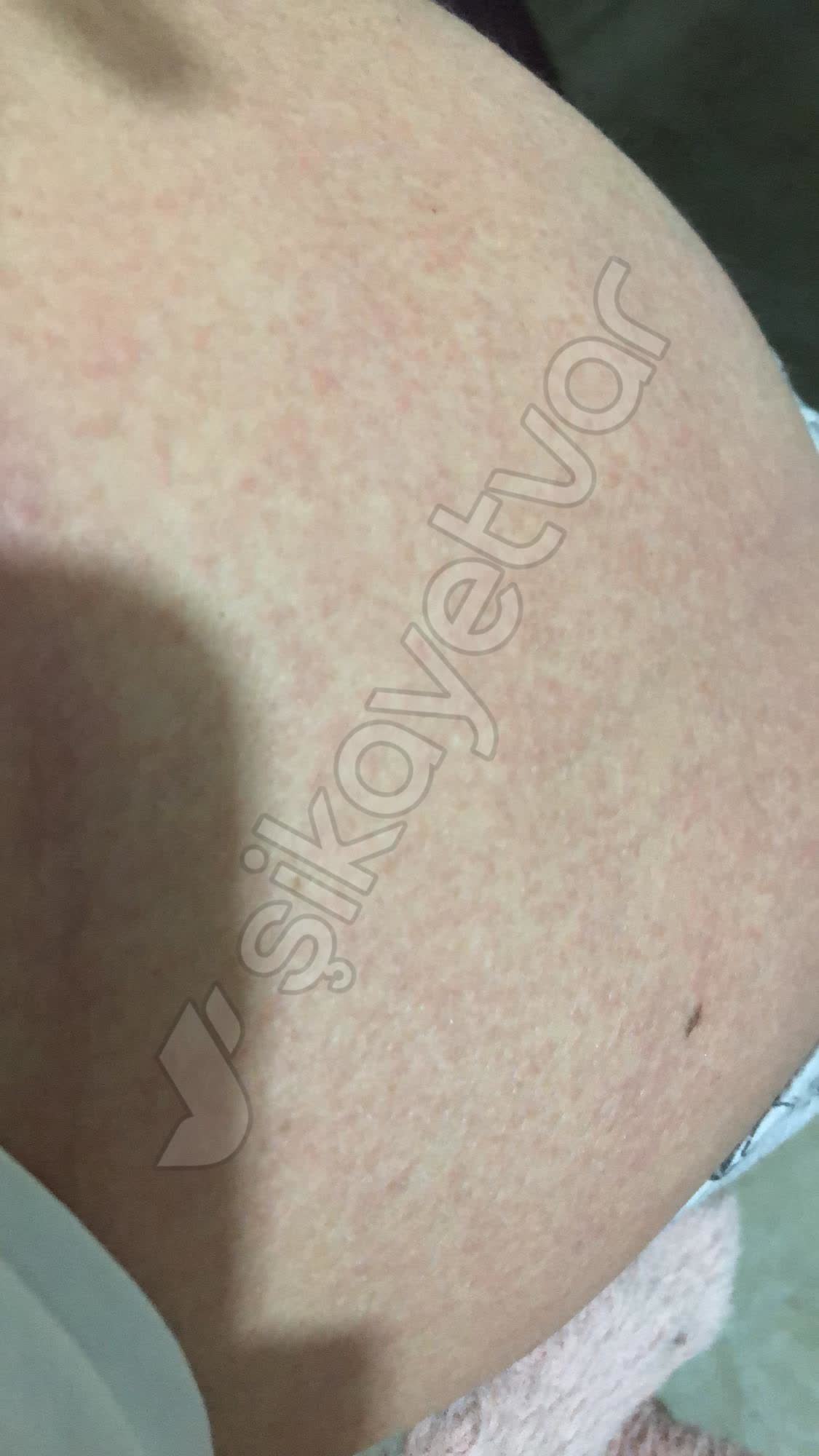 Alerji ve Aloe Vera ikayetleri - ikayetvar