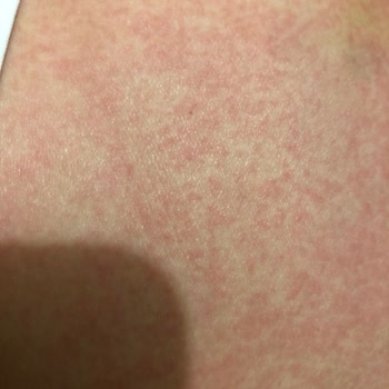 Aloe Vera Bebek Yağı Alerji Ve İsilik Yaptı