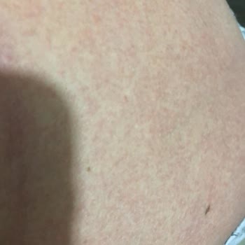 Aloe Vera Bebek Yağı Alerji Ve İsilik Yaptı