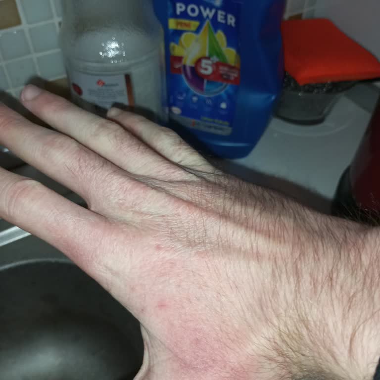 Pril Power Kullanımı Sonrası Cilt Sorunları