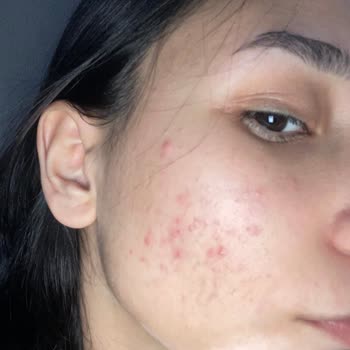 Bioderma Sebium Jel: Ciltte Alerjik Reaksiyon Ve Sivilce Sorunu