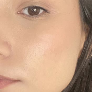 Bioderma Sebium Jel: Ciltte Alerjik Reaksiyon Ve Sivilce Sorunu