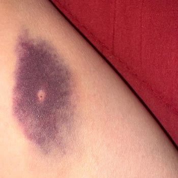 Serum Sonrası Morarma Ve İlgisizlik Sorunu