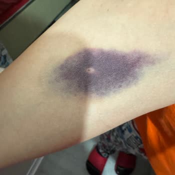 Serum Sonrası Morarma Ve İlgisizlik Sorunu