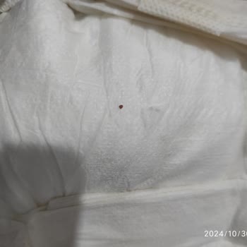 Sleepy Bebek Bezlerinde Şüpheli Lekeler Ve Sertlikler