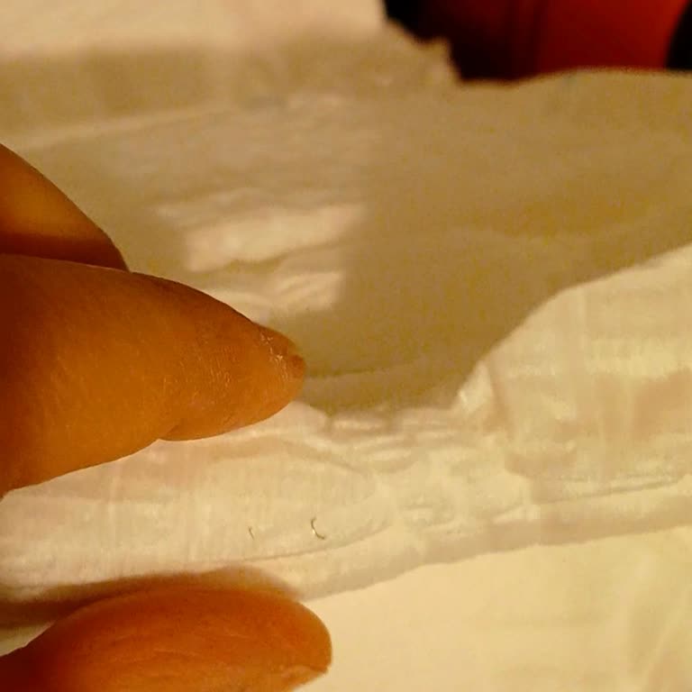 Canped Hasta Bezinden Çıkan Tel Sağlık Riski Yaratıyor