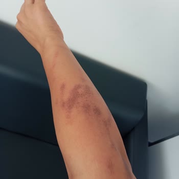 Zarafet Güzellik Merkezi'nde Yanıklarla Sonuçlanan Hizmet Sorunları