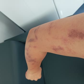 Zarafet Güzellik Merkezi'nde Yanıklarla Sonuçlanan Hizmet Sorunları