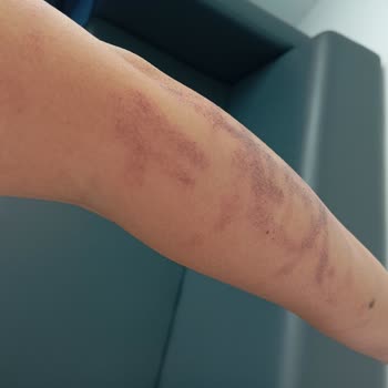 Zarafet Güzellik Merkezi'nde Yanıklarla Sonuçlanan Hizmet Sorunları