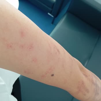 Zarafet Güzellik Merkezi'nde Yanıklarla Sonuçlanan Hizmet Sorunları