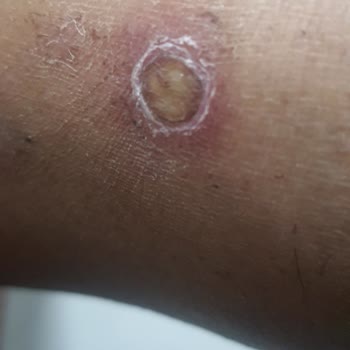 Enza Altınkum Şubesi: Yanıklar Ve İade Sorunu