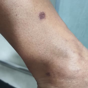 Enza Altınkum Şubesi: Yanıklar Ve İade Sorunu