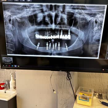 Yanlış İmplant Tedavisi Ve Saygısız Davranışlar