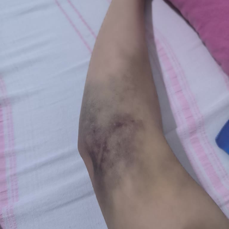 Yanlış Yapılan İğne Yüzünden Kolum Mosmor!