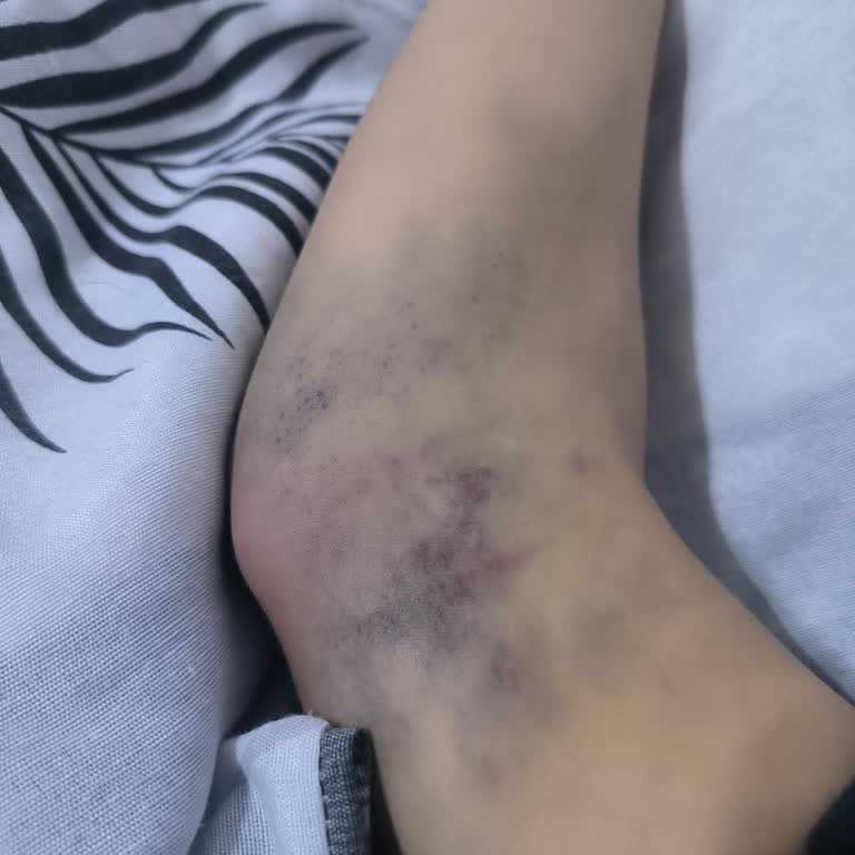 Yanlış Yapılan İğne Yüzünden Kolum Mosmor!