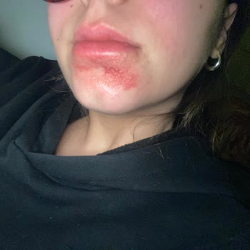 C Vitamini Serumu Yüzümü Yaktı Ve İltihaplandırdı!