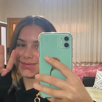 C Vitamini Serumu Yüzümü Yaktı Ve İltihaplandırdı!