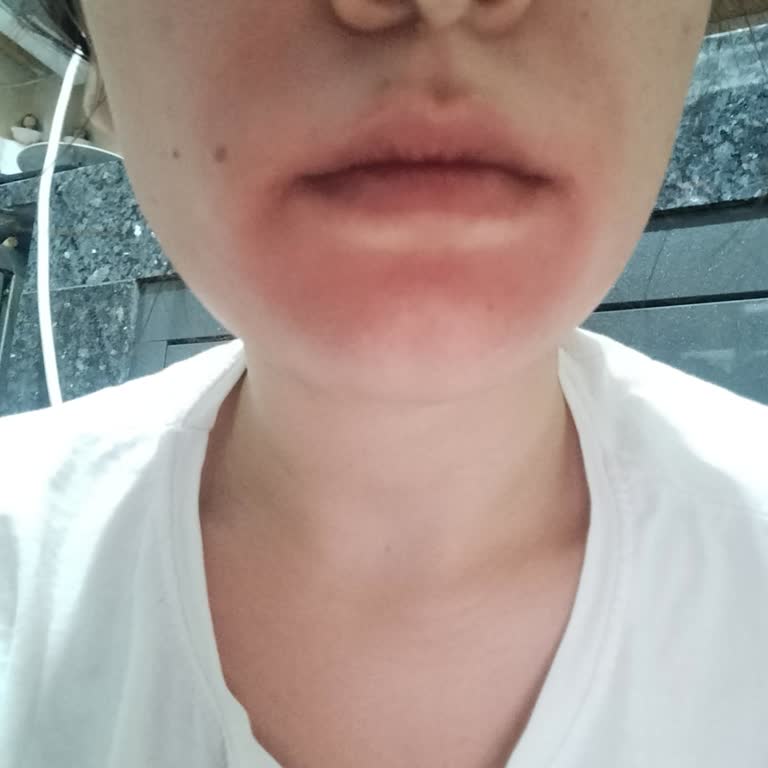 Cilt Bakım Ürünleri Kullanımı Sonrası Ciltte Tahriş Ve Yanma