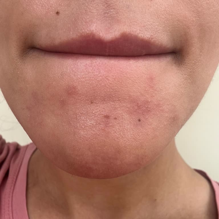 Epipera Güzellik Merkezi'nde Mağduriyet: İptal Ücreti Ve Cilt Sorunları