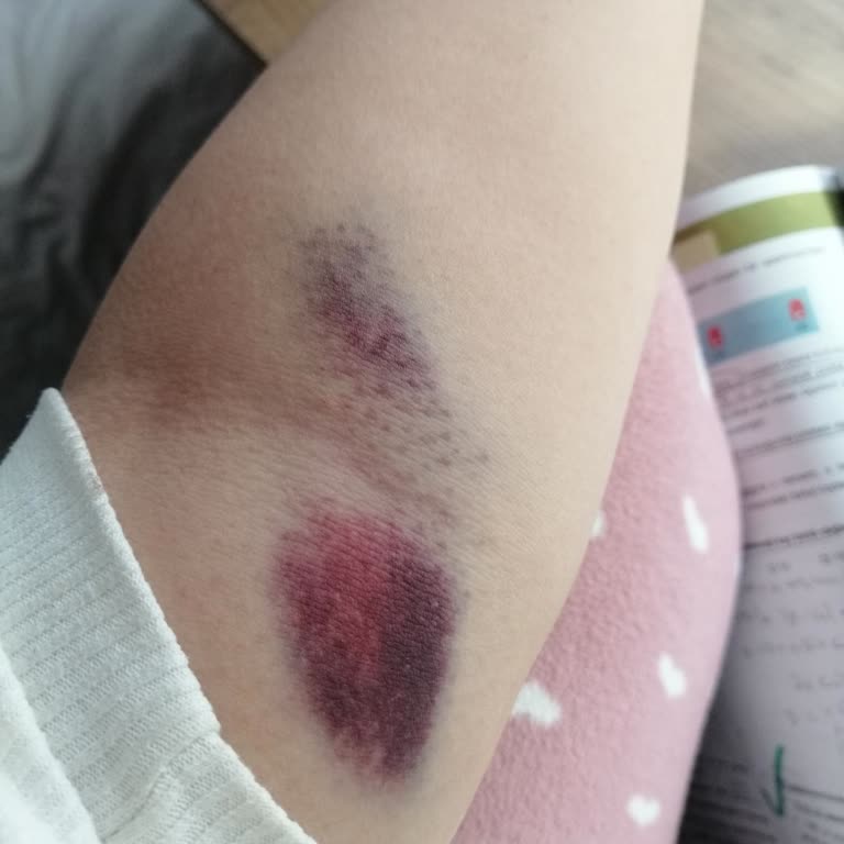 Hastanede Kan Alma Sürecinde Yaşanan Zorlayıcı Ve Acı Verici Deneyim