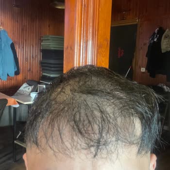 Hayal Kırıklığı Yaratan Saç Ekimi Deneyimi