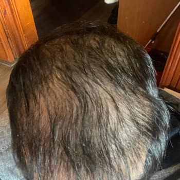 Hayal Kırıklığı Yaratan Saç Ekimi Deneyimi