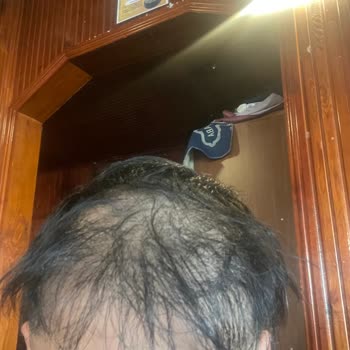 Hayal Kırıklığı Yaratan Saç Ekimi Deneyimi