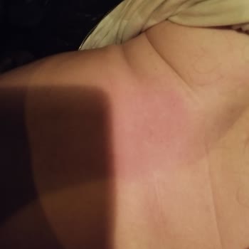 Hatalı Kahve Kapakları İle Yaşanan Yanık Sorunu