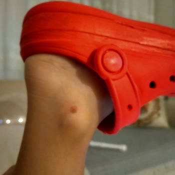 FLO Stiefel verursachen Verletzungen an Kinderfüßen und Rückgabe abgelehnt