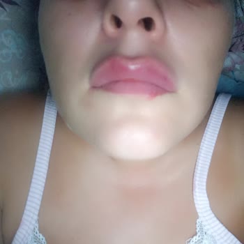 Lore Harme Beauty Başarısız Estetik İşlem Ve İletişimsizlik!