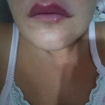 Lore Harme Beauty Başarısız Estetik İşlem Ve İletişimsizlik!